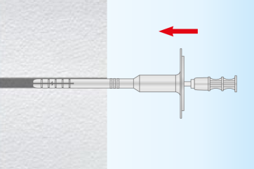 Insérer la gaine et le clou
